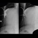 Subphrenic abscess, drainage, pig-tail, leak of contrast, fistulography: RF - Fluoroscopy